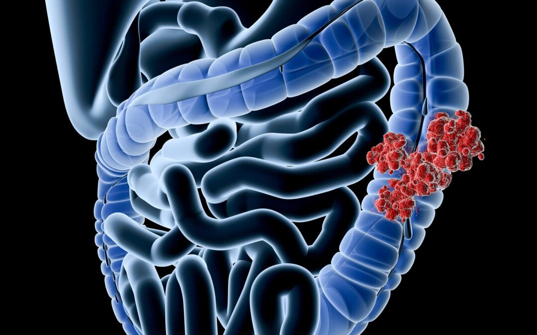 Colon Cancer, Often Avoidable, Hits Black Men, the Young More